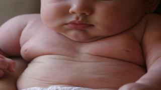 حصى الكلى عند الأطفال سببه البدانة