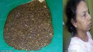 هندية تخضع لعملية جراحية لاستخراج 12 ألف حصى من مرارتها